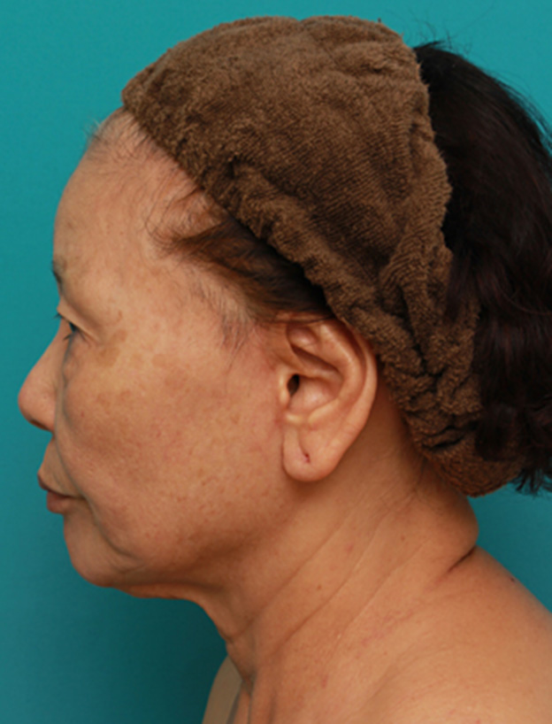 症例写真,70代女性にミニフェイスリフト（頬のたるみ取り）を行い、頬や首のたるみを改善させた症例　術前術後画像,6ヶ月後,mainpic_minilift03l.jpg