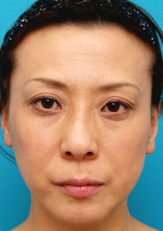 症例写真,ポニーテールリフト(小切開こめかみリフト)の症例 ぼんやりとしていた顔立ちがシャープに,After(メイクあり),