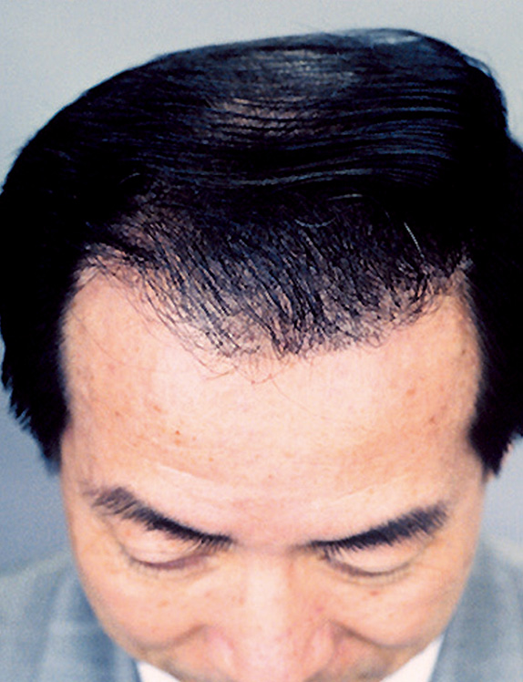 症例写真,医療植毛 後退してきた生え際が気になる50代の男性の症例,After,ba_hair08_b.jpg