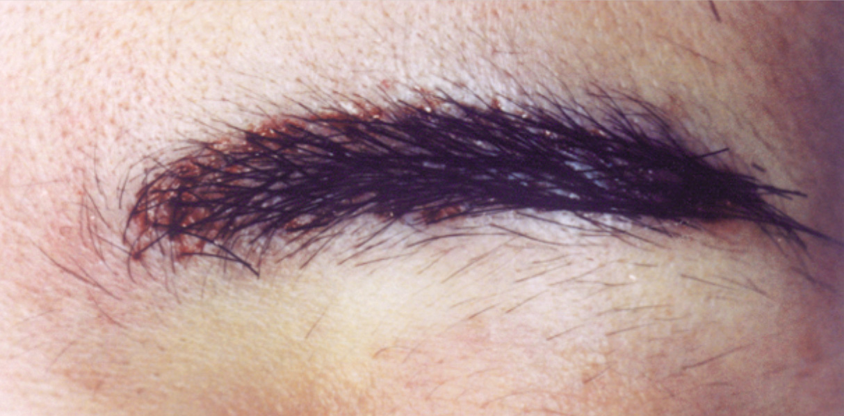 症例写真,眉毛の植毛の症例写真,After,ba_hair04_b.jpg
