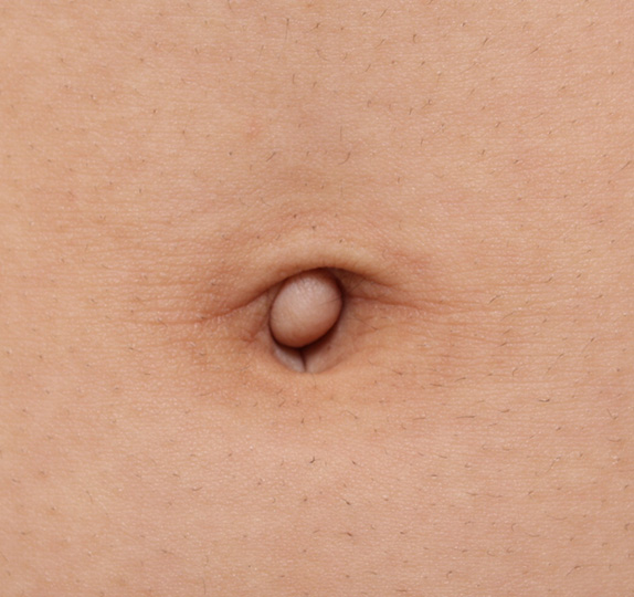 へそ形成の症例 おへその出っ張りを気にされていた10代女性,Before,ba_navel_05_b.jpg