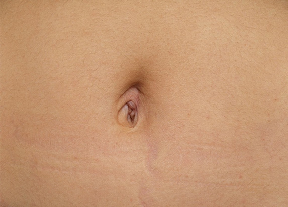 へそ形成,でべその修正手術の症例写真,After,ba_navel_08_a01.jpg