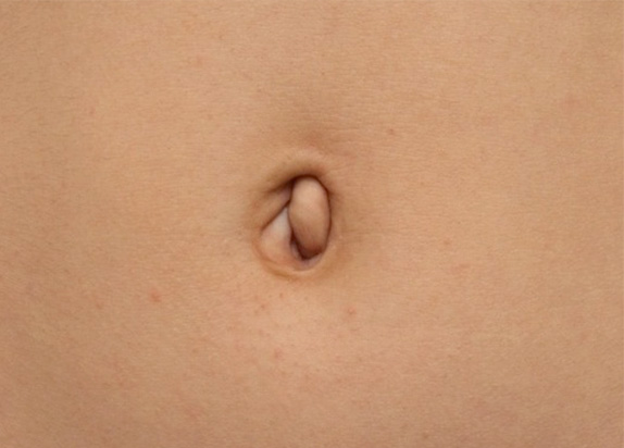 症例写真,でべその修正手術の症例写真,Before,ba_navel_08_b.jpg