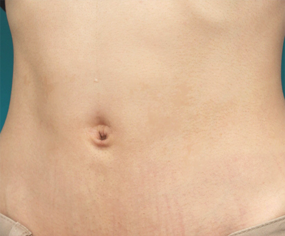 へそ形成,非常に難しい出べそ手術の症例写真,After（3ヶ月後）,ba_navel_10_b.jpg