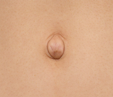 非常に難しいへそヘルニアの手術の症例写真,Before,ba_navel_11_b.jpg