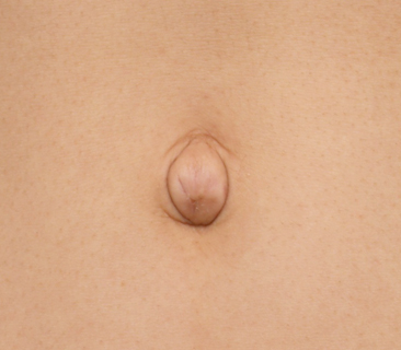 症例写真,非常に難しいへそヘルニアの手術の症例写真,手術前,mainpic_navel03a.jpg