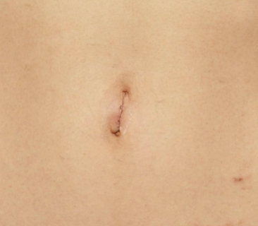 症例写真,非常に難しいへそヘルニアの手術の症例写真,6ヶ月後,mainpic_navel03c.jpg