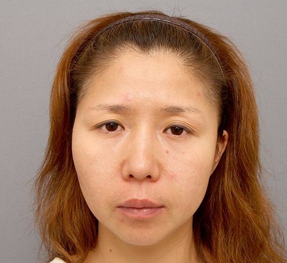 ポニーテールリフト 小切開こめかみリフト 美容整形の高須クリニック 東京赤坂 横浜 名古屋 大阪