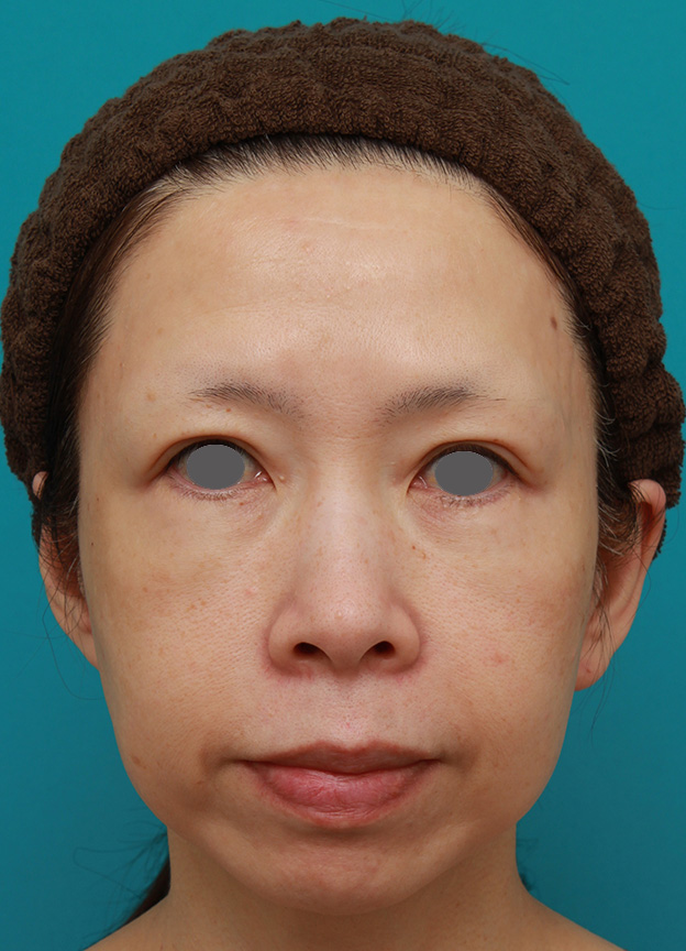 症例写真,イタリアンリフトで頬のたるみをリフトアップした50代女性の症例写真の術前術後画像,1ヶ月後,mainpic_italian07c.jpg