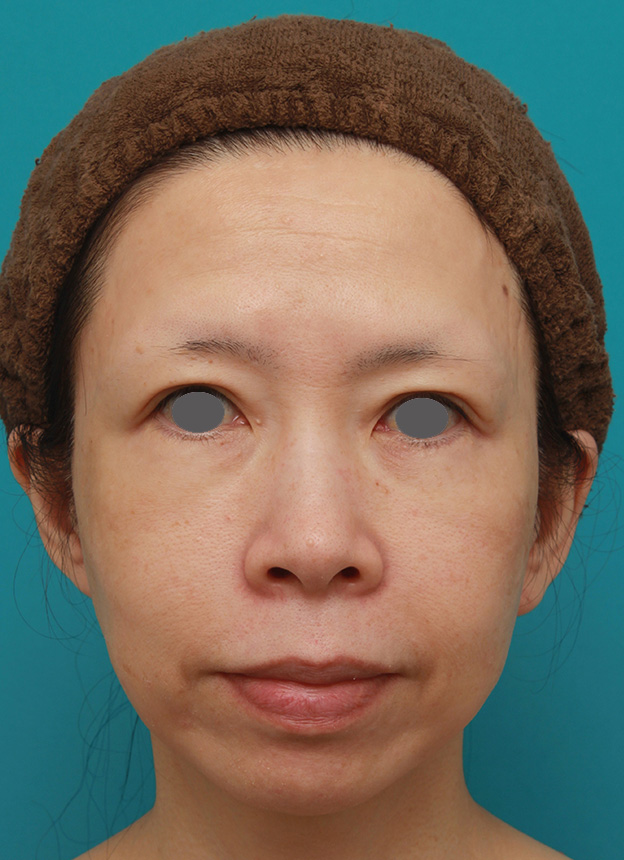 症例写真,イタリアンリフトで頬のたるみをリフトアップした50代女性の症例写真の術前術後画像,3ヶ月後,mainpic_italian07d.jpg