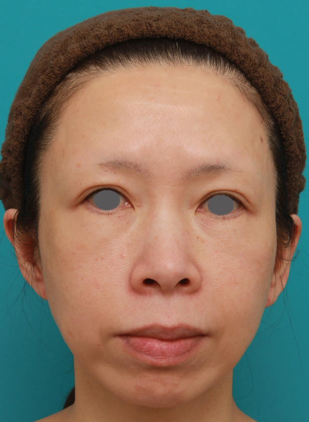 症例写真,イタリアンリフトで頬のたるみをリフトアップした50代女性の症例写真の術前術後画像,6ヶ月後,mainpic_italian07e.jpg