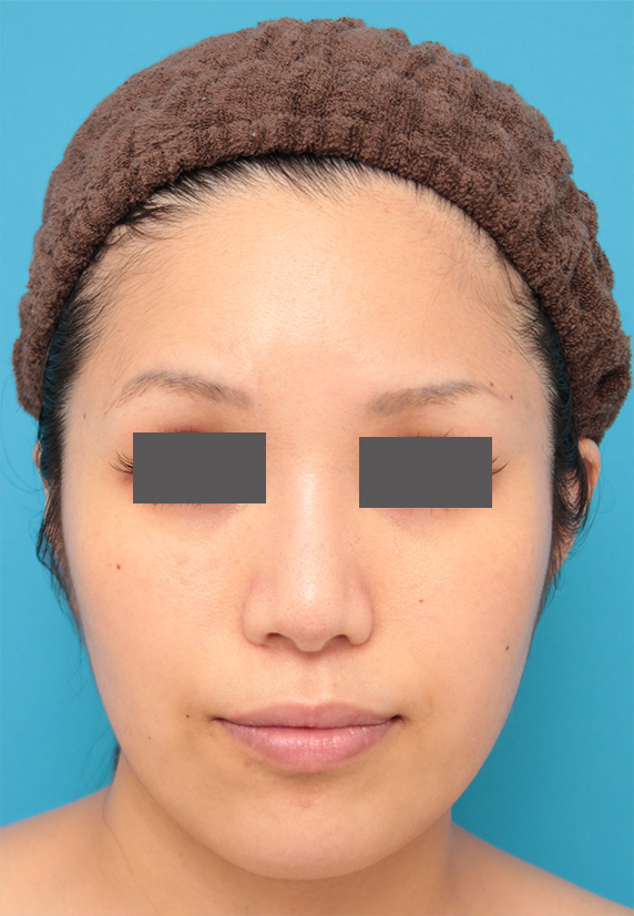 症例写真,イタリアンリフト+バッカルファット除去で小顔効果、たるみ引き締め効果を出した症例写真の術前術後画像,After（6ヶ月後）,ba_italian22_b.jpg
