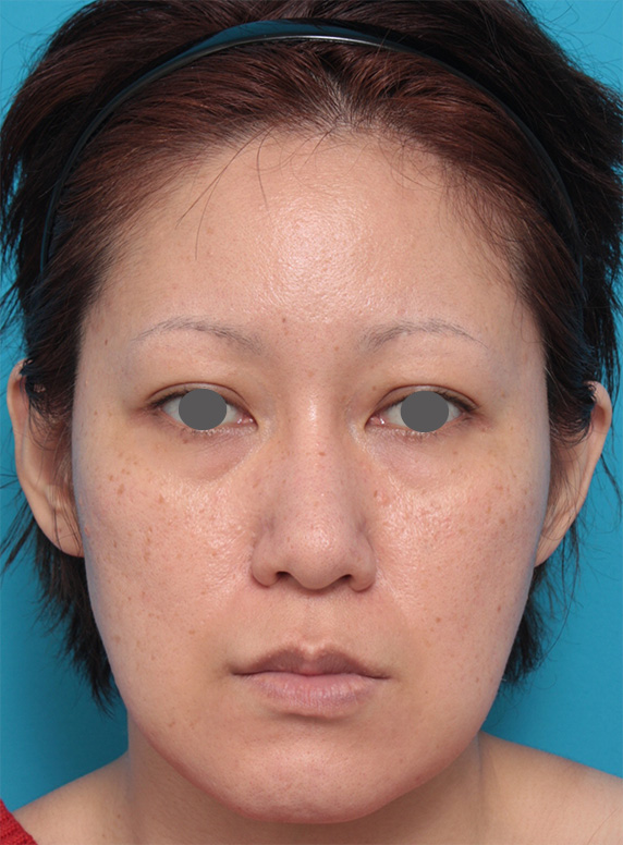 症例写真,イタリアンリフトで頬のたるみを改善させた症例写真の術前術後画像,Before,ba_italian23_b.jpg