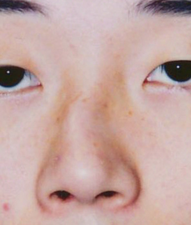 斜鼻修正（曲がった鼻をまっすぐに）の症例写真,Before,ba_shabi01_b.jpg
