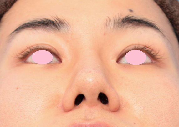 症例写真,眉間プロテーゼ+鼻プロテーゼ+鼻先耳介軟骨移植+小鼻縮小手術の症例写真,After（8ヶ月後）,ba_glabella04_b.jpg