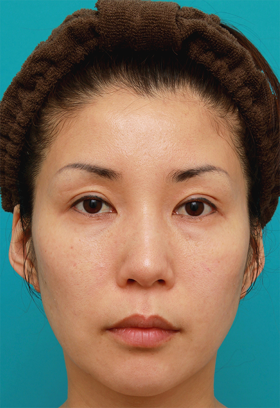 40代女性の顔全体にイタリアンリフトファインを行い、肌の張りを出した症例写真の術前術後画像,Before,ba_italianlift_fine11_b.jpg