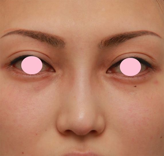 眉間から鼻にかけてシリコンプロテーゼを入れ、かなり高くし、鼻筋を通した症例写真の術前術後画像,Before,ba_glabella07_b.jpg
