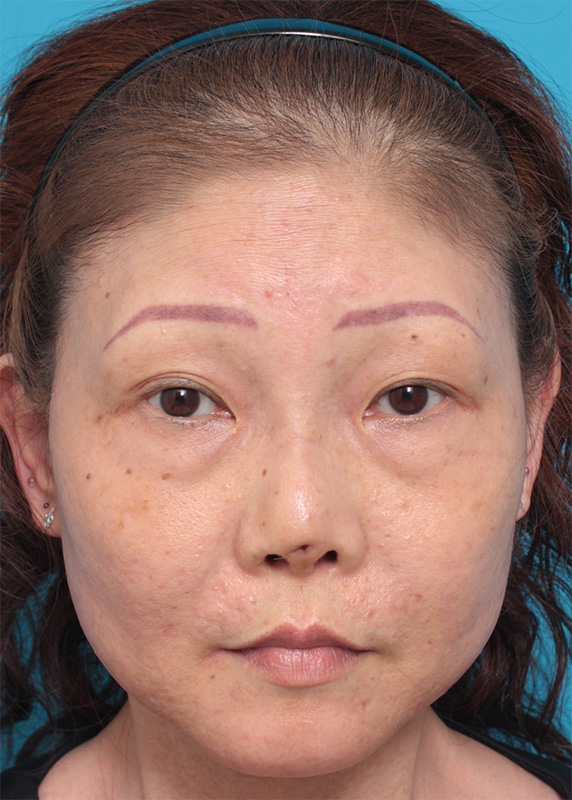 症例写真,鼻のシリコンプロテーゼ抜き（除去）他院治療の修正症例,After（1週間後）,ba_prosthesis_removal01_b.jpg