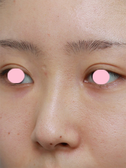 症例写真,他院で鼻に注入されたアクアミドを除去した症例写真,After（1週間後）,ba_hanaaquamid02_b.jpg