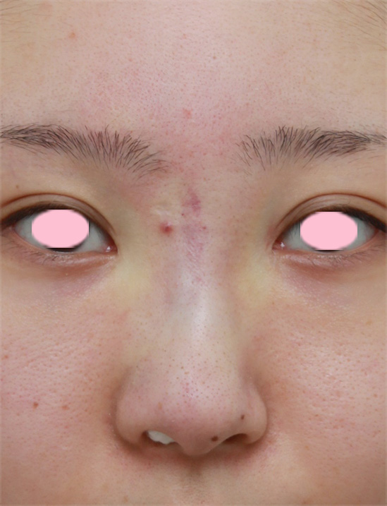 症例写真,他院で鼻に注入されたアクアミドを除去した症例写真,手術直後,mainpic_hanaaquamid01b.jpg