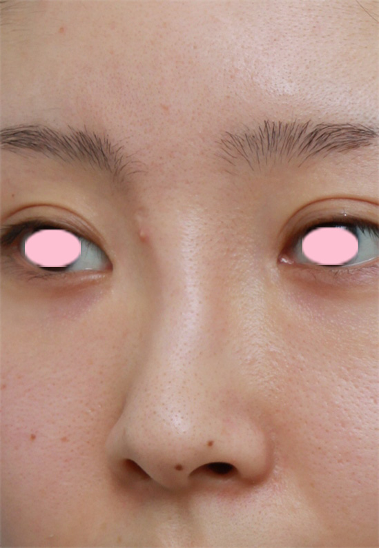 症例写真,他院で鼻に注入されたアクアミドを除去した症例写真,手術前,mainpic_hanaaquamid02a.jpg