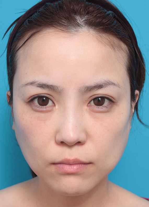 症例写真,30代女性に行った金の糸（ゴールデンリフト）症例写真,Before,ba_goldlift_pic13_b.jpg