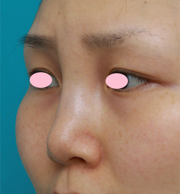 症例写真,鼻に注入されたアクアミドorアクアジェルorバイオアルカミドと思われる注入物を除去した症例,Before,ba_hanaaquamid04_b.jpg