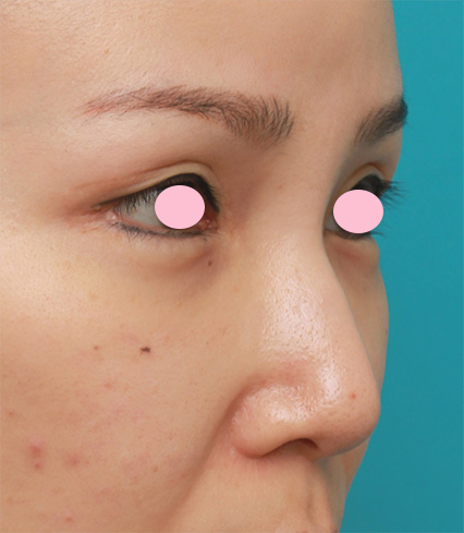 症例写真,他院で鼻にエンドプロテーゼ(エンドプラスト)を入れてデコボコになってしまい除去した症例写真,After（1ヶ月後）,ba_modify02_b.jpg
