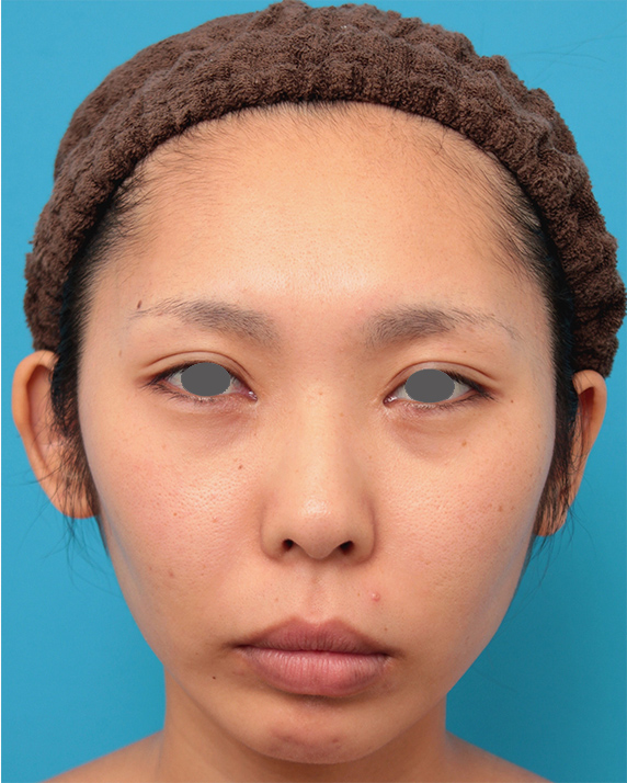 金の糸（ゴールデンリフト）で顔全体の肌の張りが出で、引き締まった印象になった20代女性の症例写真,Before,ba_goldlift21_b.jpg