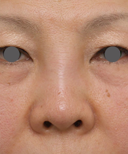 症例写真,他院で安価なヒアルロン酸を鼻に注射してアバターのようになった方の修正症例写真,Before,ba_hyaluronjyokyo01_b.jpg
