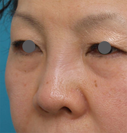 症例写真,他院で安価なヒアルロン酸を鼻に注射してアバターのようになった方の修正症例写真,Before,ba_hyaluronjyokyo02_b.jpg