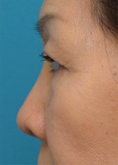 症例写真,他院で安価なヒアルロン酸を鼻に注射してアバターのようになった方の修正症例写真,After（ヒアルロニダーゼ注射後1週間）,ba_hyaluronjyokyo03_b.jpg