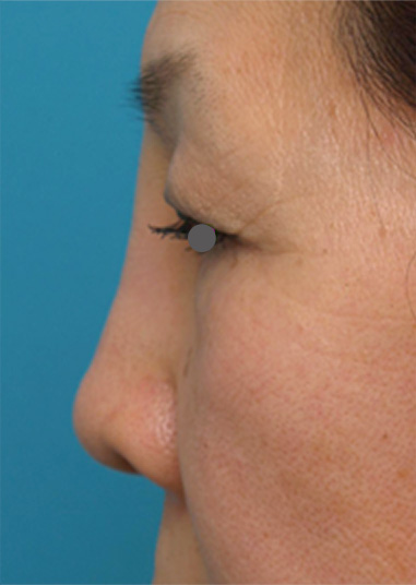 症例写真,他院で安価なヒアルロン酸を鼻に注射してアバターのようになった方の修正症例写真,Before,ba_hyaluronjyokyo03_b.jpg