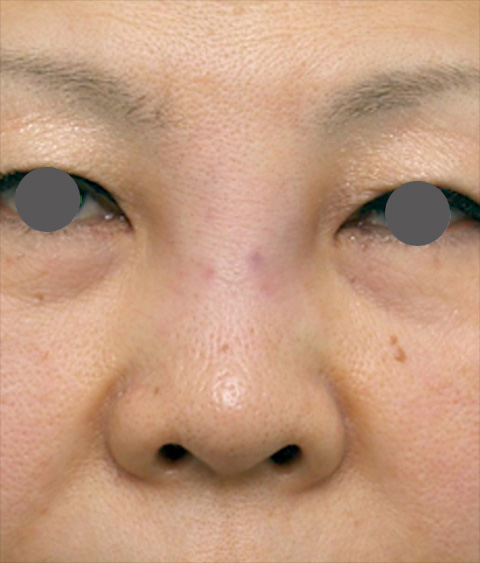 症例写真,他院で安価なヒアルロン酸を鼻に注射してアバターのようになった方の修正症例写真,ヒアルロニダーゼ注射直後,mainpic_hyaluronjyokyo_01b.jpg