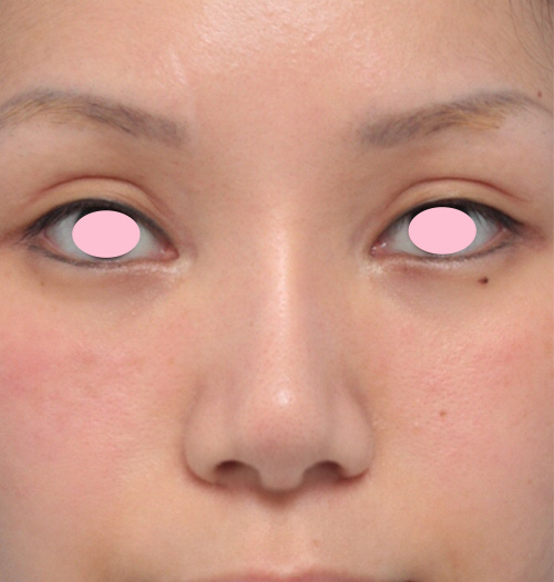 症例写真,他院で入れた鼻のL型シリコンプロテーゼをI型に入れ替えて耳介軟骨移植と鼻翼縮小を行った症例写真,手術前,mainpic_modify02a.jpg