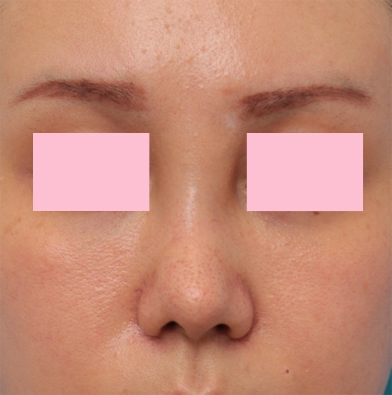 他院で鼻に注入されたアクアミドらしき物を手術で除去した症例写真の術前術後画像,Before,ba_modify06_b.jpg