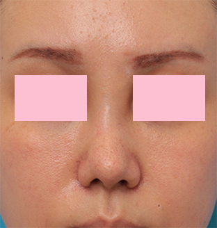 症例写真,他院で鼻に注入されたアクアミドらしき物を手術で除去した症例写真の術前術後画像,来院時,mainpic_modify03a.jpg