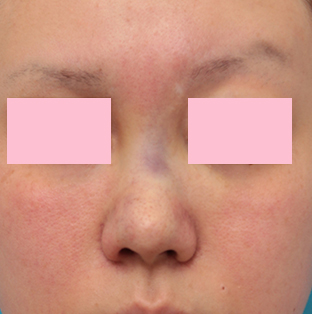 症例写真,他院で鼻に注入されたアクアミドらしき物を手術で除去した症例写真の術前術後画像,アクアミド除去手術直後,mainpic_modify03b.jpg