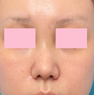 症例写真,他院で鼻に注入されたアクアミドらしき物を手術で除去した症例写真の術前術後画像,1週間後,mainpic_modify03c.jpg