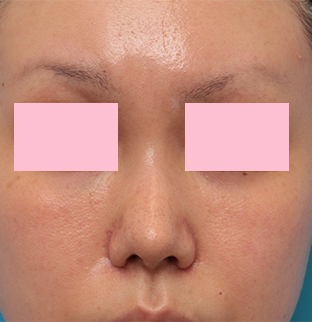 症例写真,他院で鼻に注入されたアクアミドらしき物を手術で除去した症例写真の術前術後画像,3週間後,mainpic_modify03d.jpg