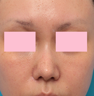 症例写真,他院で鼻に注入されたアクアミドらしき物を手術で除去した症例写真の術前術後画像,3ヶ月後,mainpic_modify03e.jpg