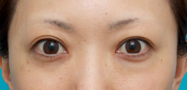 症例写真,他院で目の下に質の悪いヒアルロン酸を注射され凸凹になり、ヒアルロニダーゼで改善させた症例写真,注射前,mainpic_hyaluronjyokyo03a.jpg