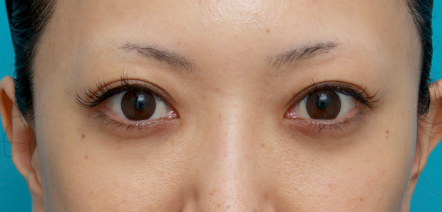 症例写真,他院で目の下に質の悪いヒアルロン酸を注射され凸凹になり、ヒアルロニダーゼで改善させた症例写真,1ヶ月後,mainpic_hyaluronjyokyo03c.jpg