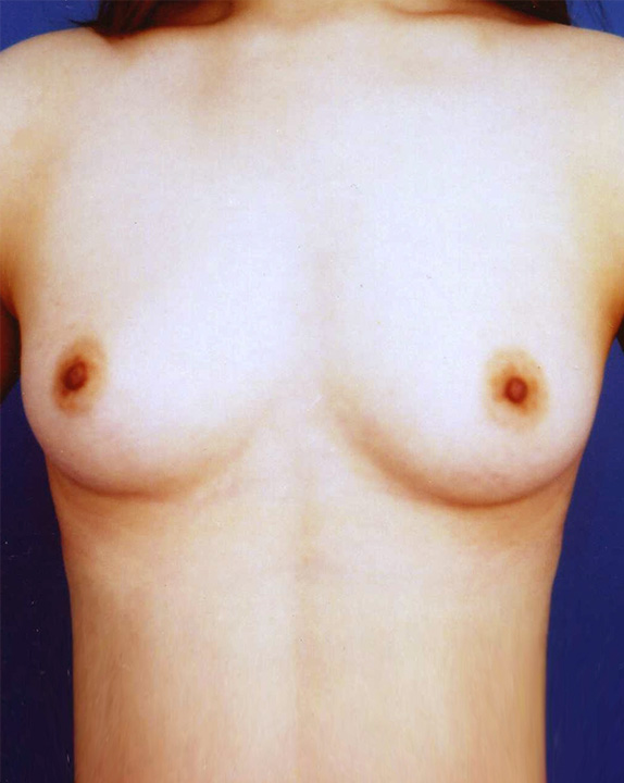 症例写真,乳腺下に300CCずつ,Before,ba_hokyo39_b.jpg
