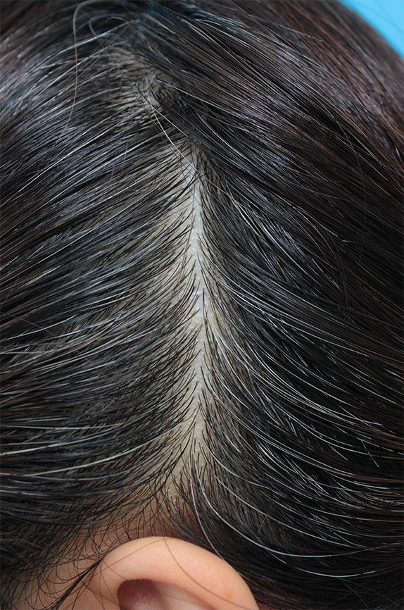 CO2レーザーで頭皮のほくろを除去した症例写真,After（10ヶ月後）,ba_hokuro_ibo_aza22_a01.jpg