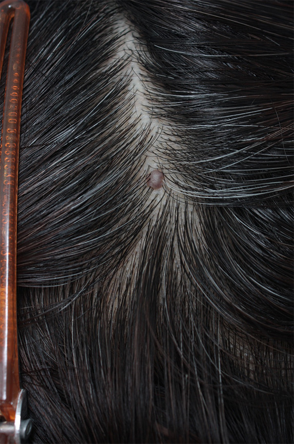 症例写真,CO2レーザーで頭皮のほくろを除去した症例写真,Before,ba_hokuro_ibo_aza22_b.jpg