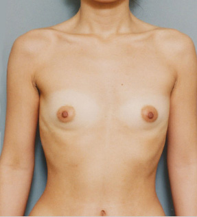 豊胸手術（シリコンプロテーゼ）の症例 乳腺下に240CCずつ挿入,Before,ba_hokyo31_b.jpg