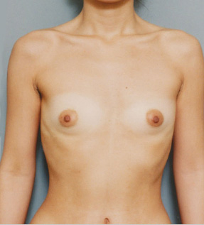 豊胸手術（シリコンプロテーゼ）の症例 乳腺下に240CCずつ挿入,Before,ba_hokyo31_b.jpg