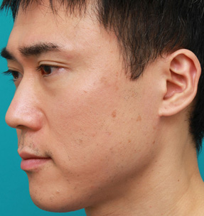 症例写真,顔の盛り上がったシミ（セボケラ、脂漏性角化症）をCO2レーザーアブレージョンで治療した症例写真,Before,ba_hokuro_ibo_aza23_b.jpg
