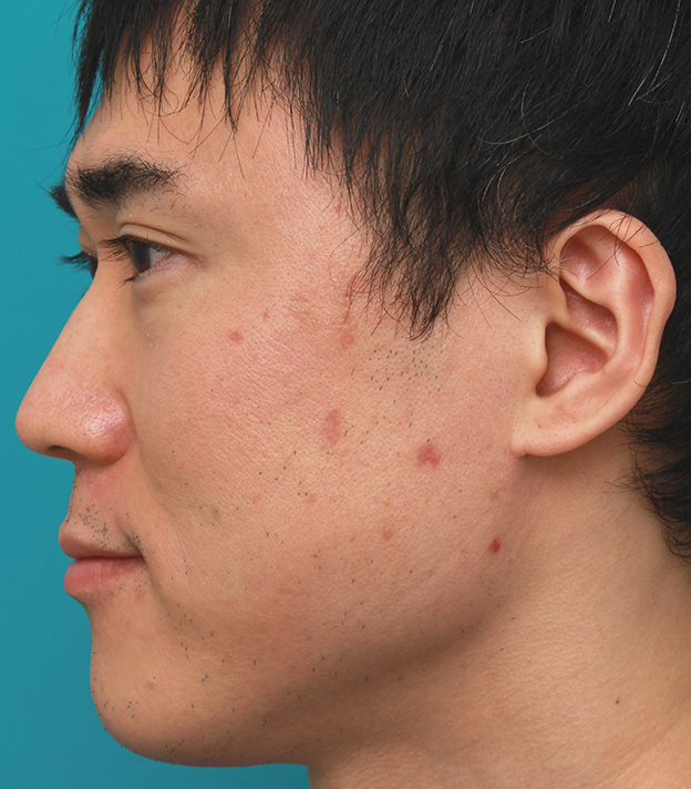 症例写真,顔の盛り上がったシミ（セボケラ、脂漏性角化症）をCO2レーザーアブレージョンで治療した症例写真,1週間後,mainpic_hokuro_ibo_aza06c.jpg